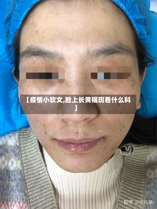 【疫情小软文,脸上长黄褐斑看什么科】-第2张图片